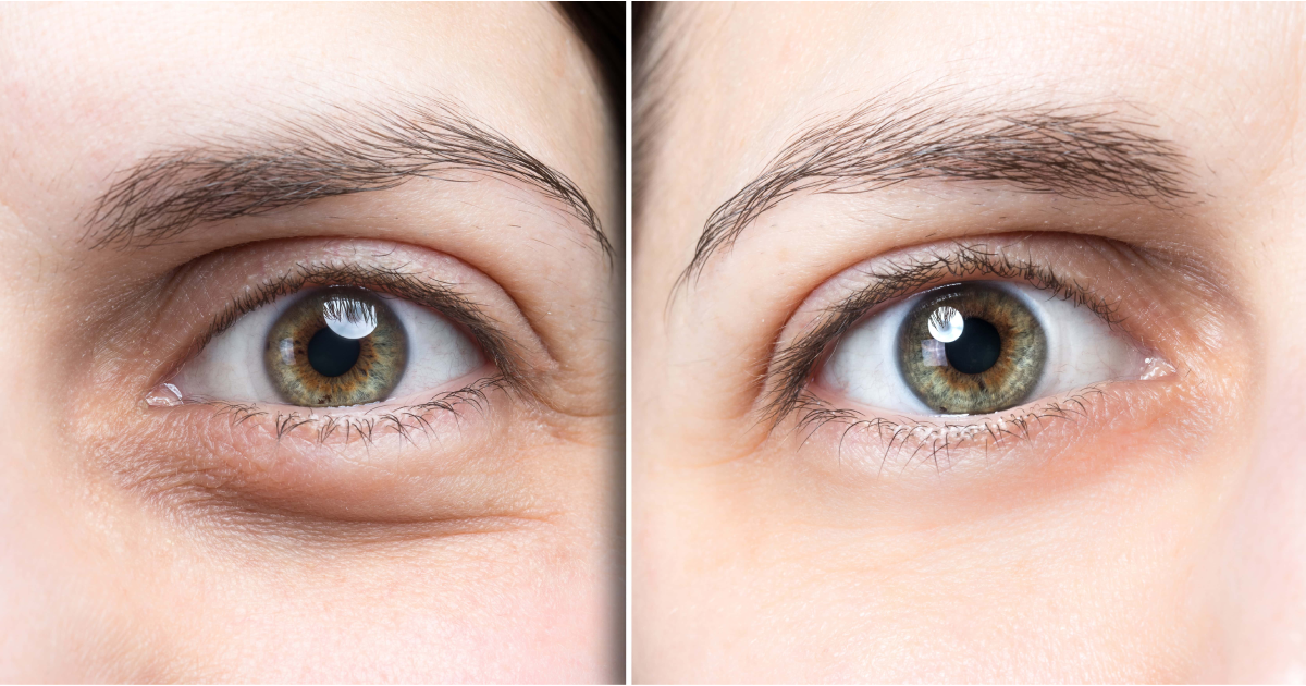 How Bright Eyes Correction Can Transform Your Face